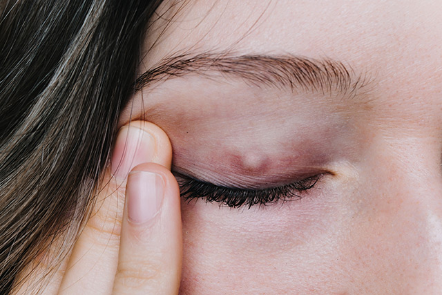 Chalazion – Causes Side Effects And Treatments At